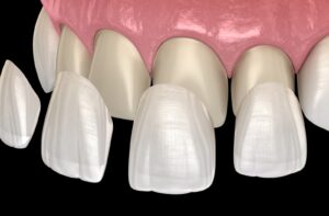 dental veneer